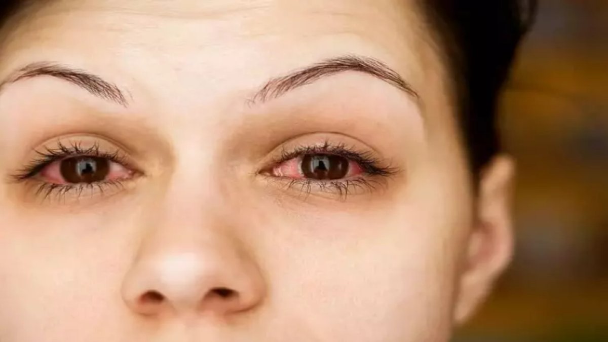 Göz Enfeksiyonuna Ne İyi Gelir?