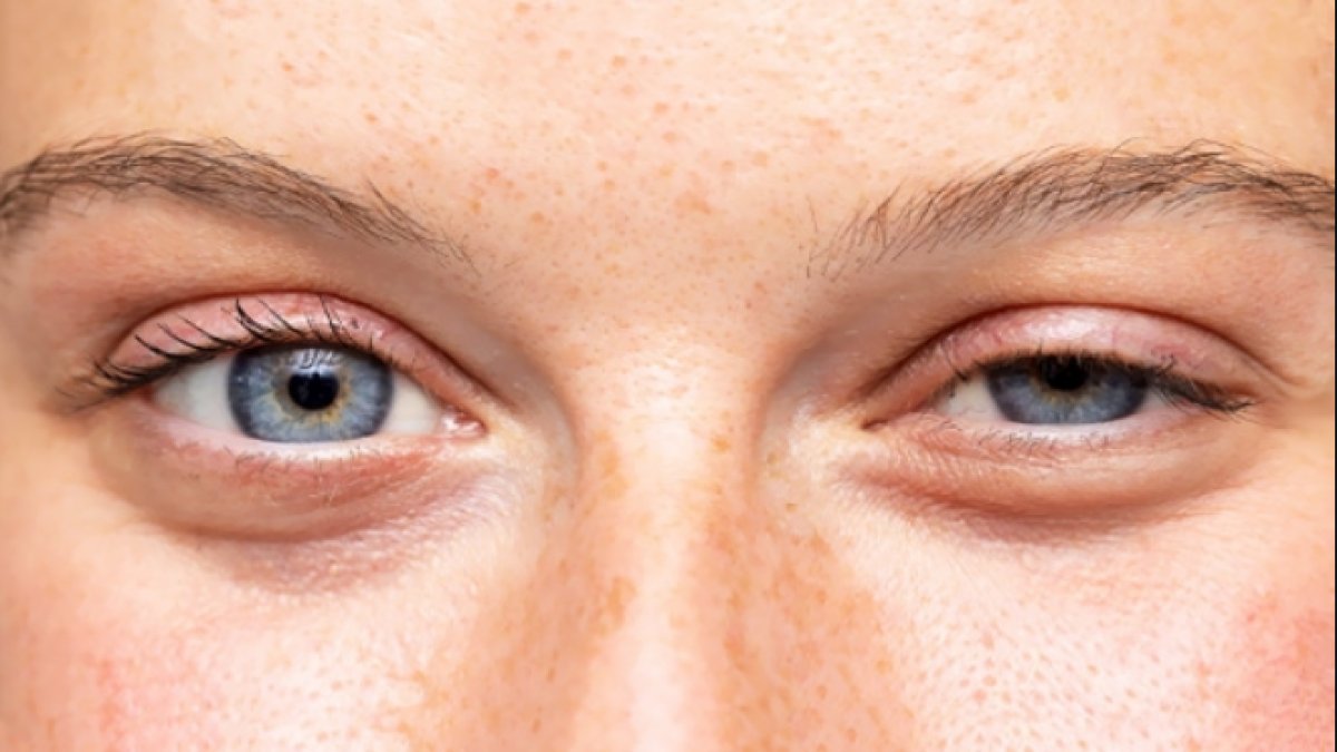 Göz Kapağı Düşüklüğü: Belirtileri, Tedavisi ve Önleme Yolları