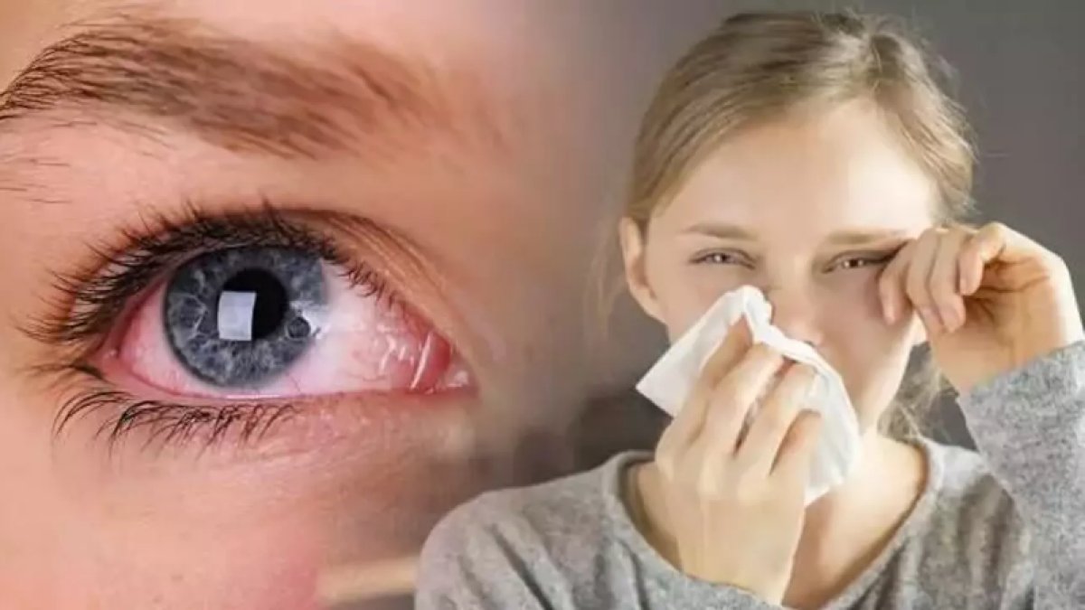 Göz Nezlesine Ne İyi Gelir?
