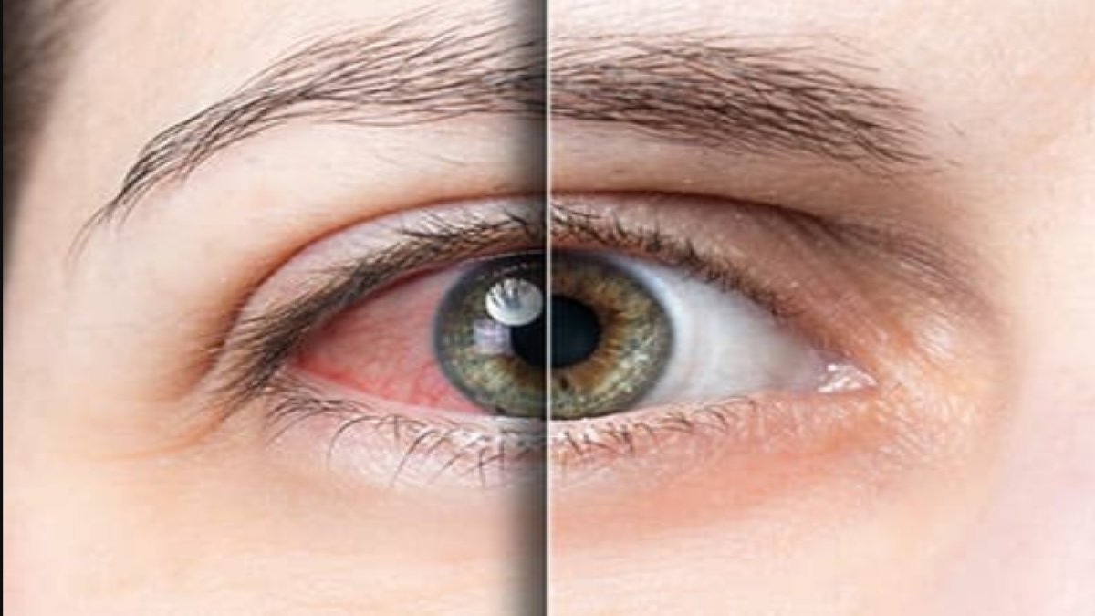 Göz Tansiyonu Nedir?