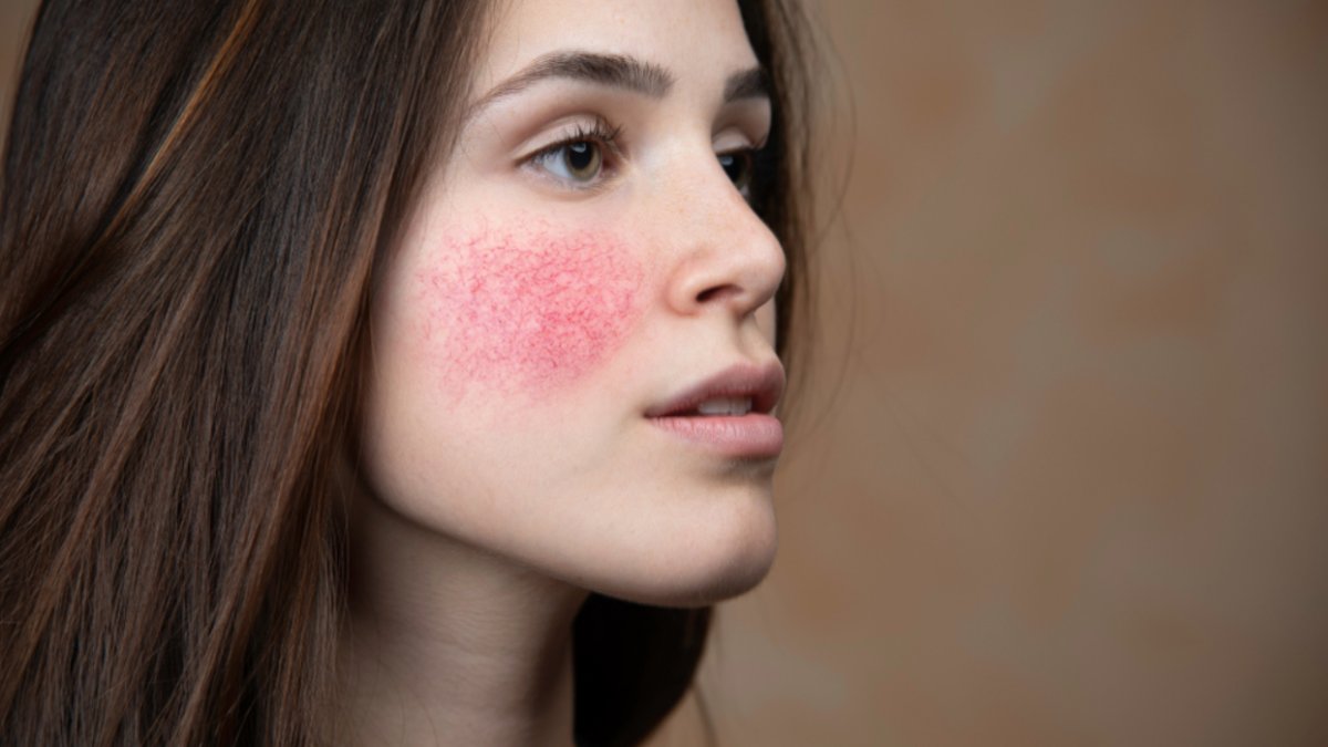 Gül Hastalığı Nedir?