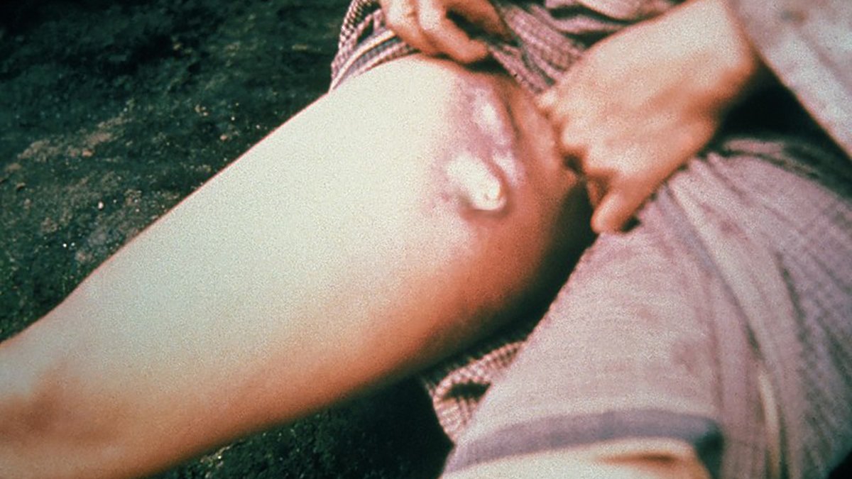 'Kara Ölüm' olarak da biliniyor! Yıllar sonra ilk vaka ortaya çıktı