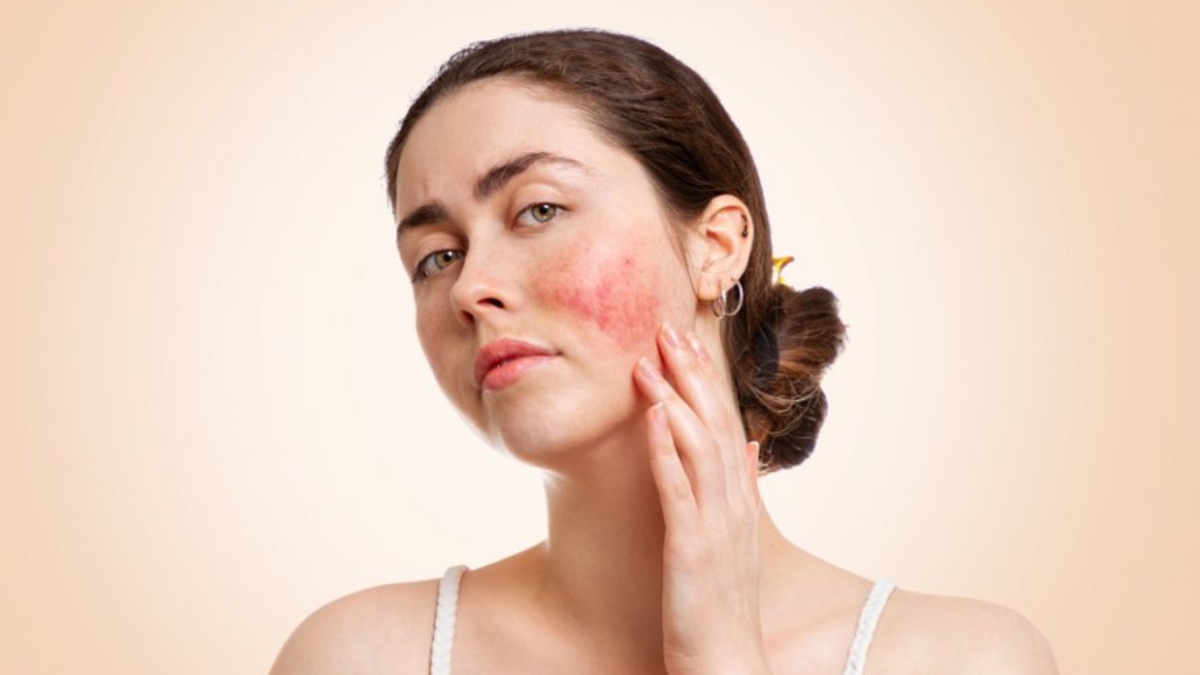 Kelebek hastalığı (Lupus) nedir? Belirtileri ve tedavi yöntemleri nelerdir?