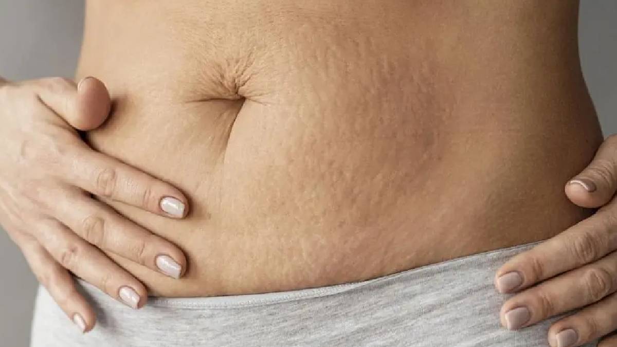 Selülit nedir? Ve selülit nasıl geçer?