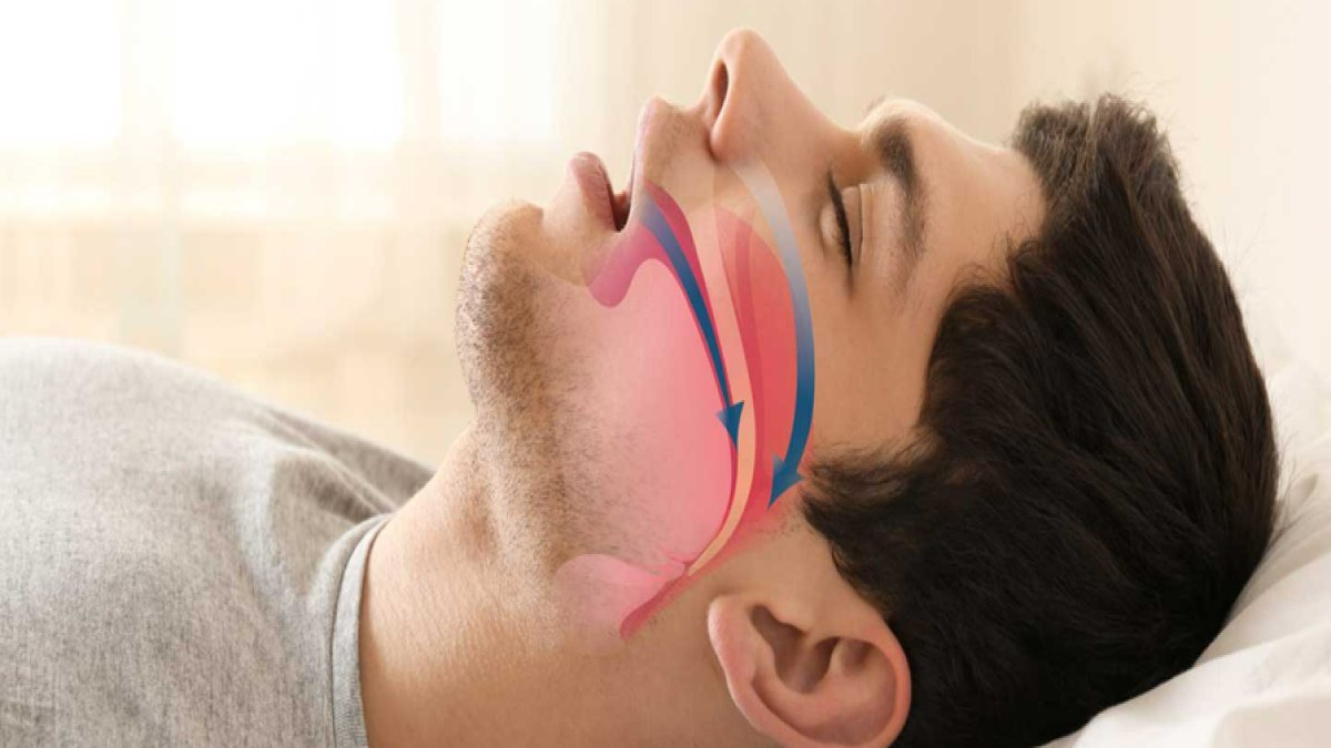 Horlamaya Ne İyi Gelir: Rahat Bir Uyku İçin Etkili Çözümler