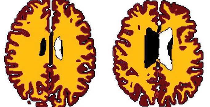 Fazla kilo beyni küçültüyor
