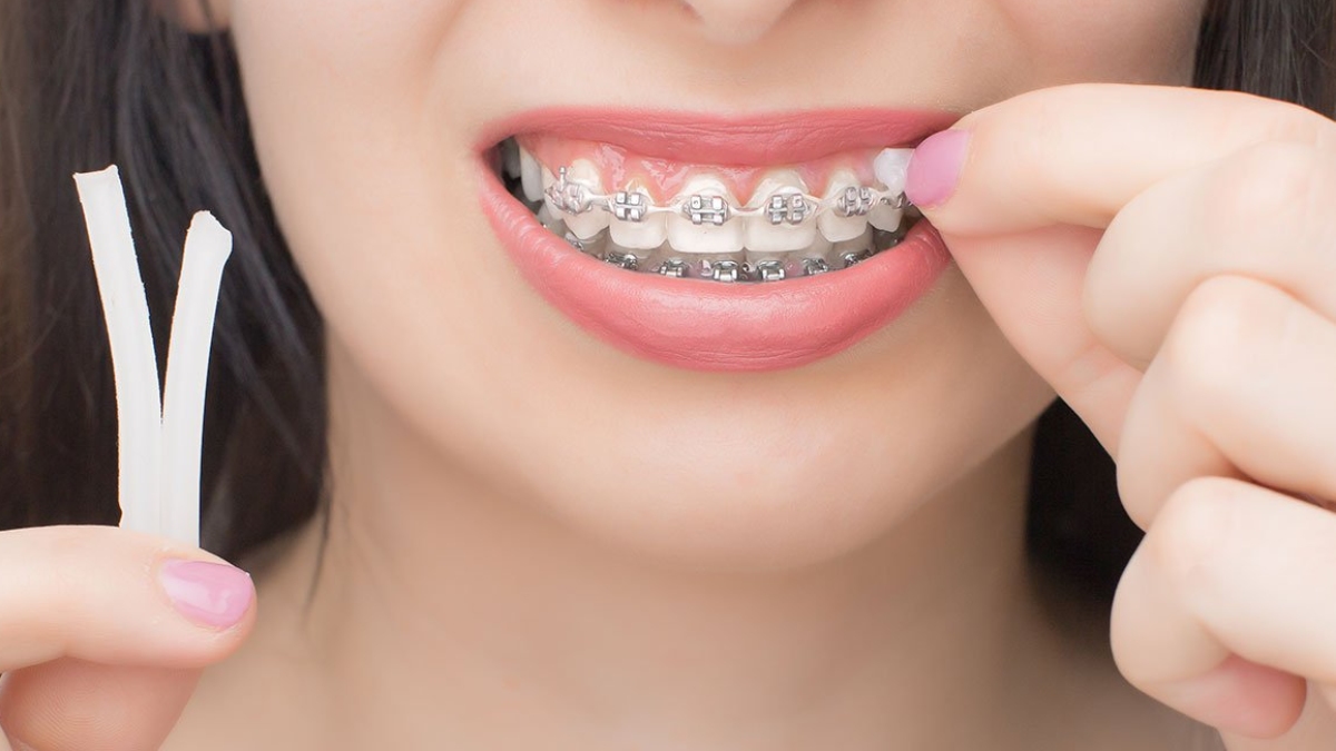 Ortodonti mumu nasıl kullanılır?