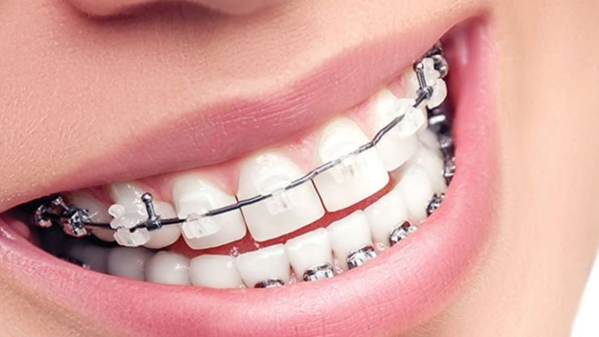 Ortodonti tedavisi ne kadar sürer?
