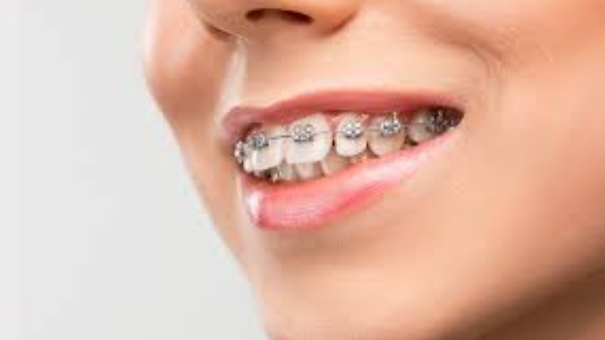 Ortodonti tedavisinde dişler ne zaman düzelir?