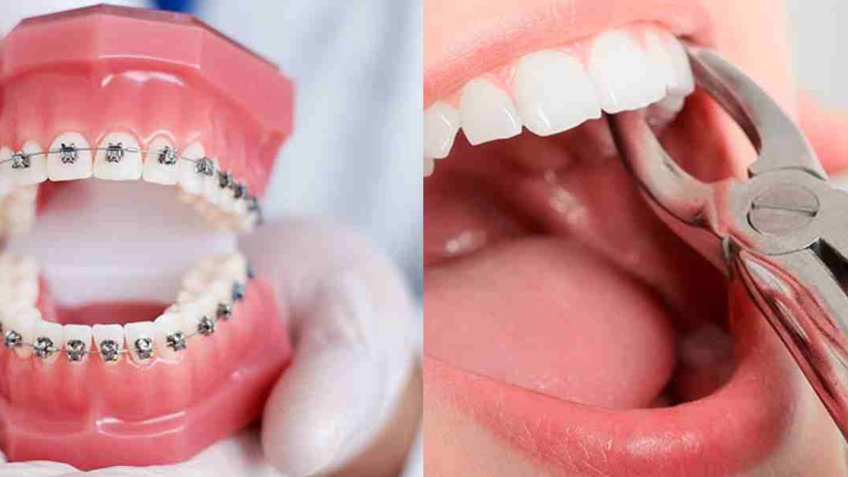 Ortodonti tedavisinde hangi dişler çekilir?