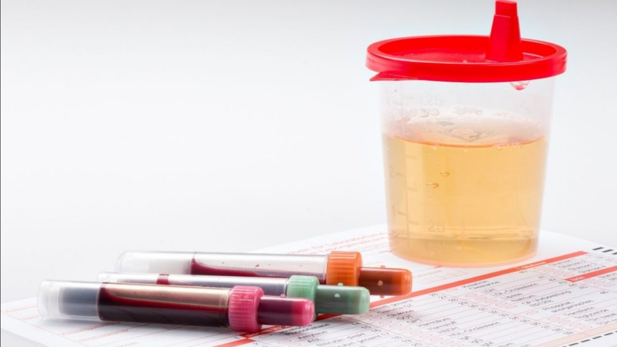 İdrardan Kan Gelmesi: Erkeklerde Görülen Bir Sorun