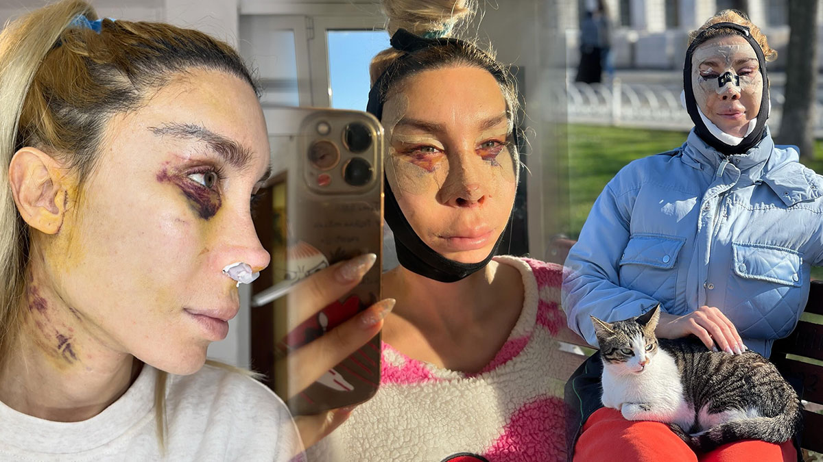 Survivor yarışmacısına estetik şoku: Hiç kimse tanıyamadı! Bandajlarını çıkarınca ilk sözleri şaşırttı