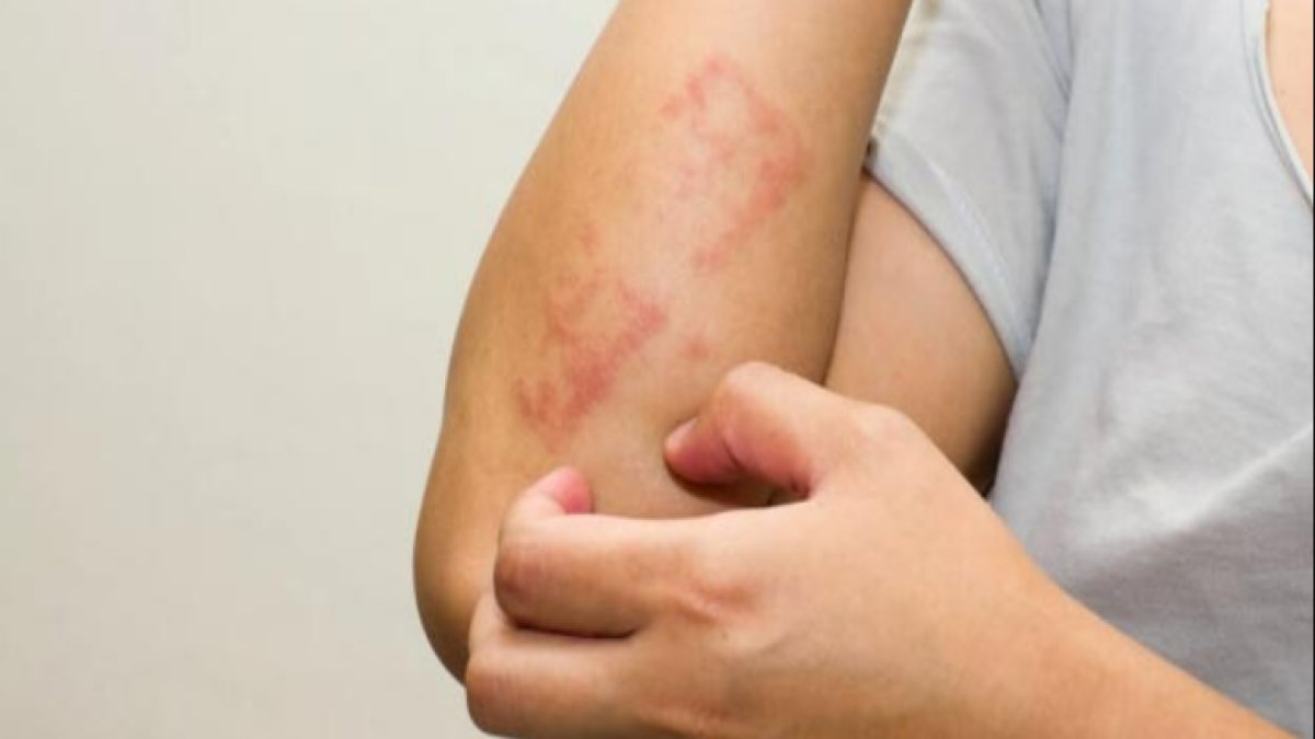 İlik Kanseri Belirtileri