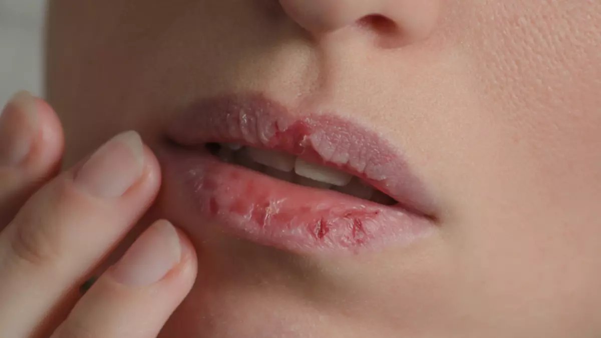 Kışın kabusu çatlak dudaklar! Meğer çatlak dudaklar için o yöntem asla yapılmamalıymış! Onun yerine bunu deneyin