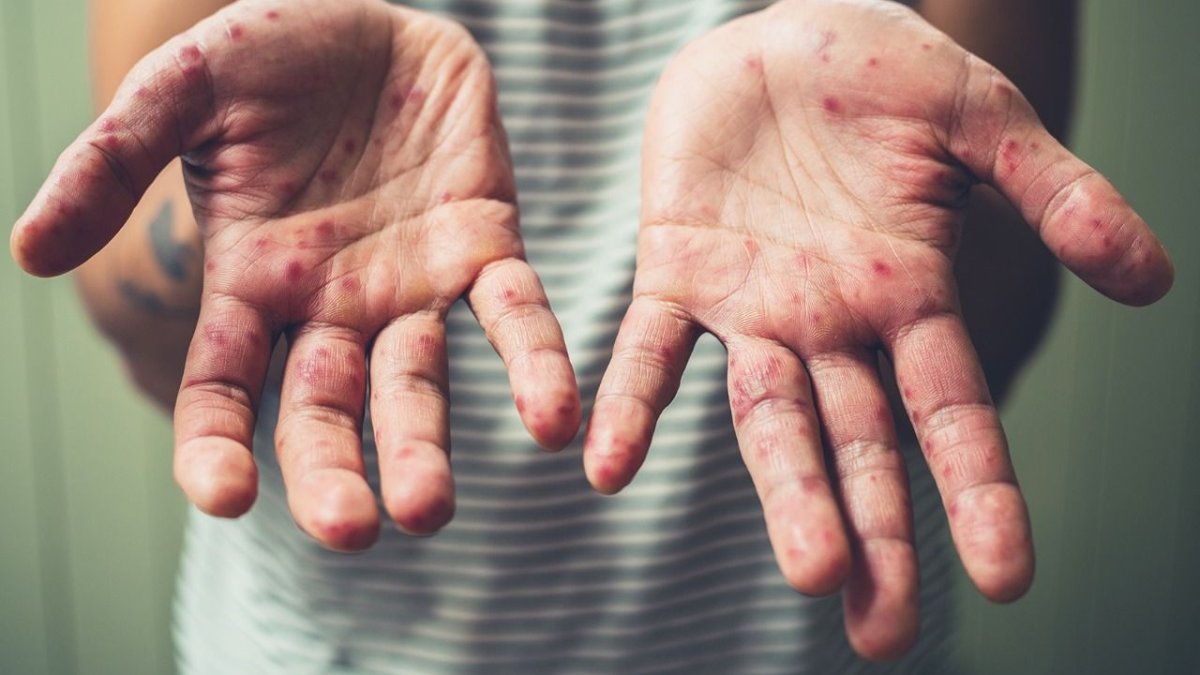 Aşı karşıtlığı kızamık vakalarını tetikledi