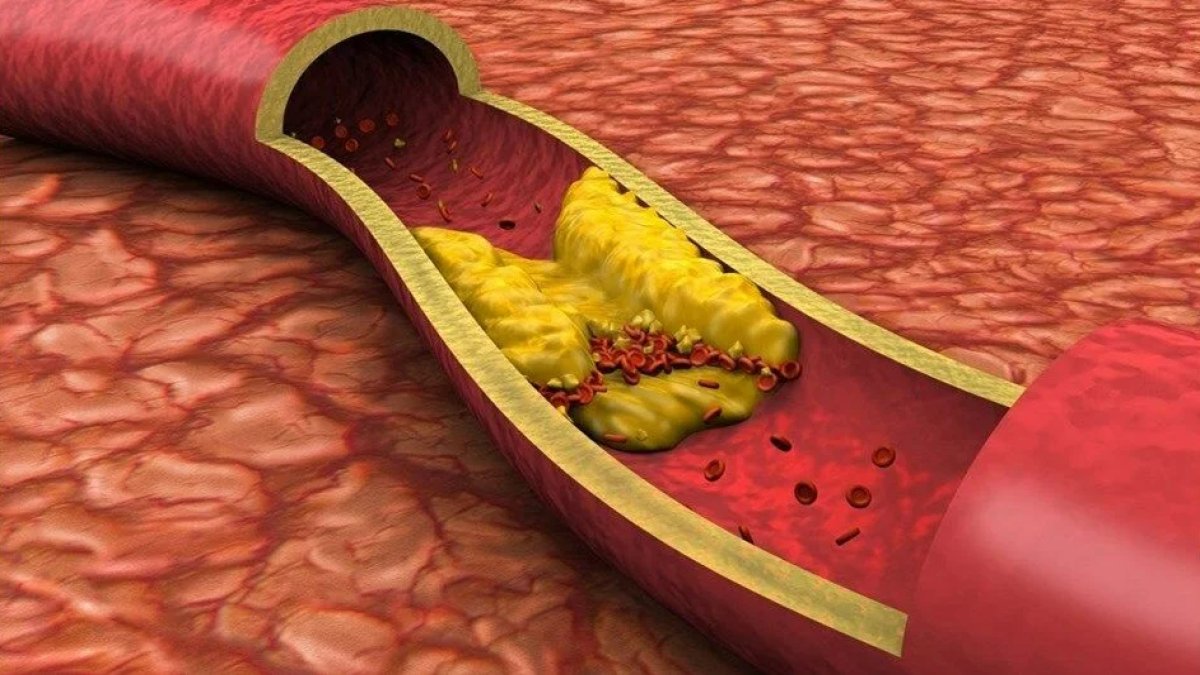 Kan Pıhtılaşması Nedir?