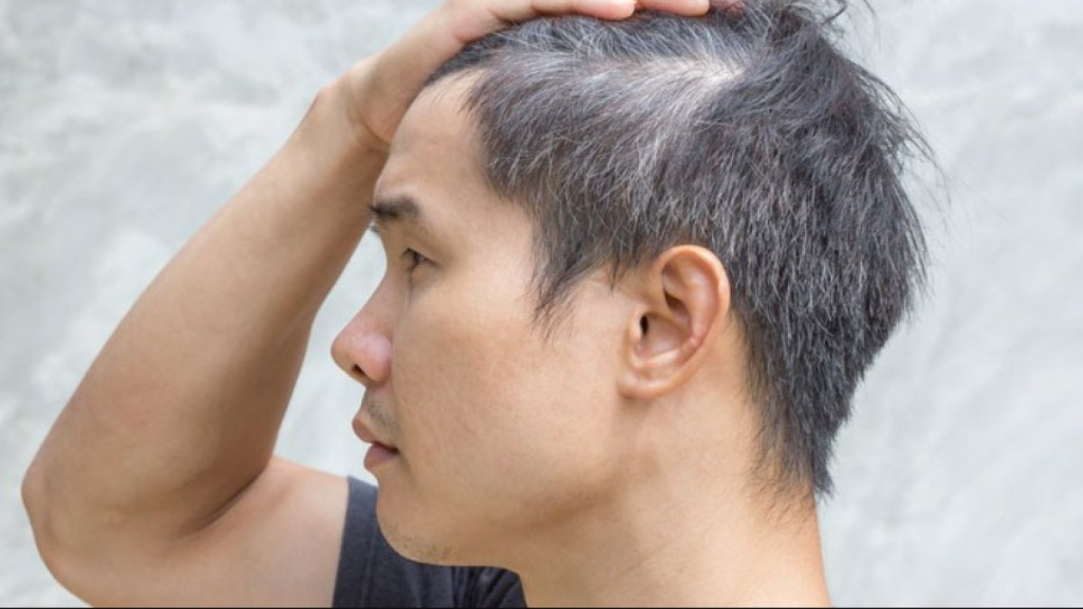 Kepek Neden Olur: Saç Derisinin Sağlık ve Bakımı Hakkında Bilmeniz Gerekenler