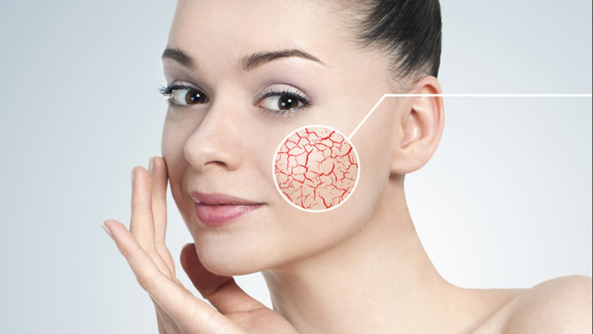 Kılcal Damar Çatlaması: Belirtileri, Tedavisi ve Önleme Yolları