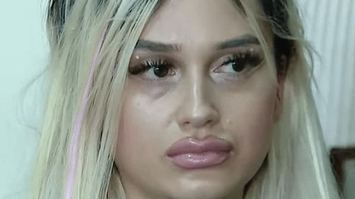 Estetik ameliyat sonrası başına gelmeyen kalmadı! 'İçeriye bir şey sıkışmış gibi hissediyorum'