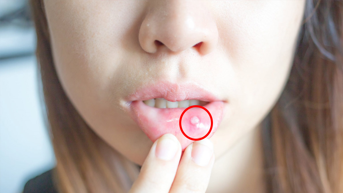 Ağızda çıkan yaralar için net çözüm Limon-tuz ikilisi! Karıştırıp sürünce yaraların kökünü kurutuyor