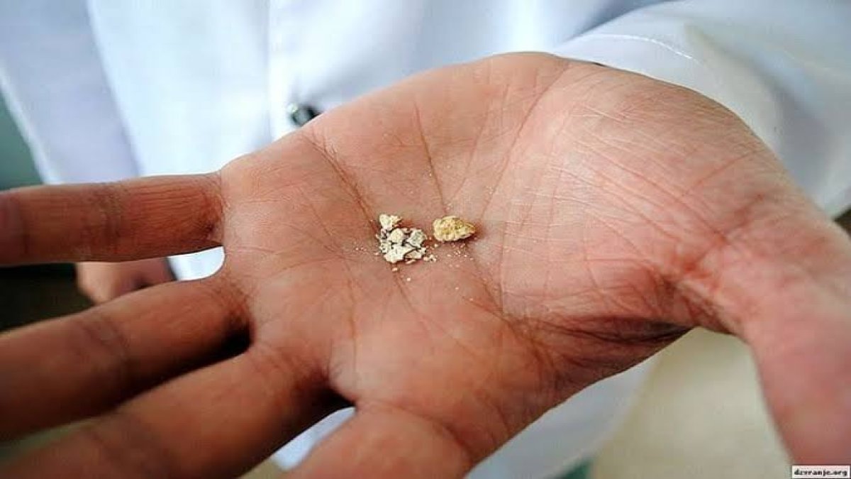 Aç karnına 1 bardak için böbrek taşlarını patır patır döküyor! Hem karaciğeri hem dalağı tertemiz yapıyor