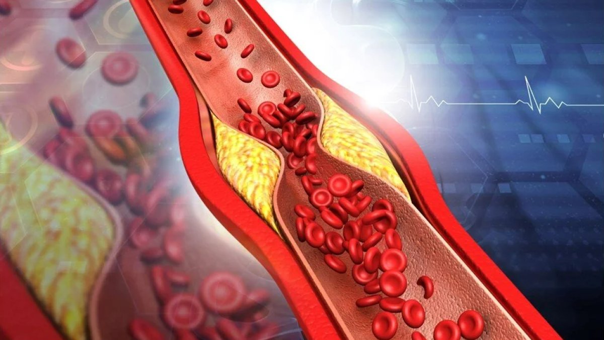 Kolesterol Neden Olur?