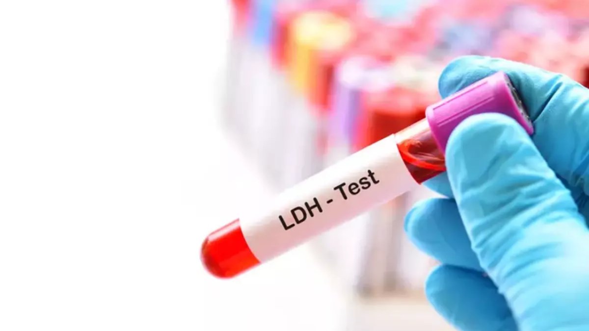 Laktat Dehidrogenaz Yüksekliği