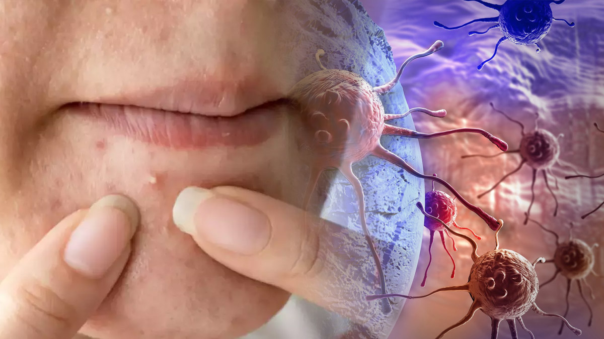 Sivilce için krem kullananlar dikkat! O kremler kanser yapıyor: Hem de dünyanın en ünlüsü