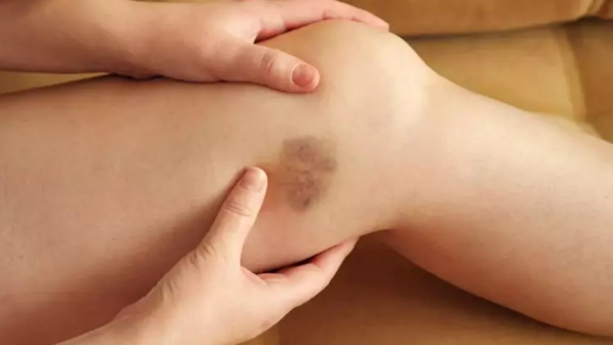 Lösemi İlk Belirti: Erken Teşhis Hayat Kurtarır