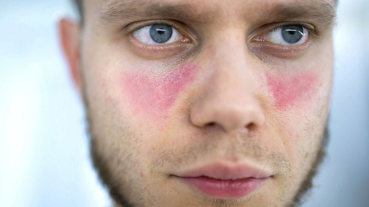 Lupus Hastalığı Nedir?