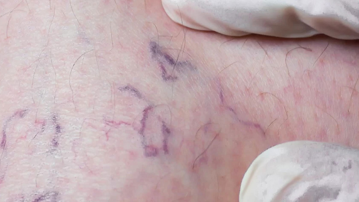 Kadınlarda daha çok görülüyor: Böyle lekeler varsa ölümcül olabilir! Kalıcı hasarlara neden olabilir, aman dikkat