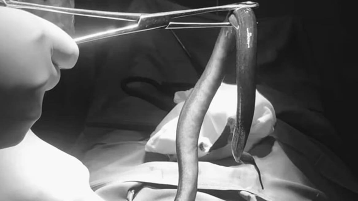 Vücudundan ameliyatla canlı yılan balığı çıkarıldı