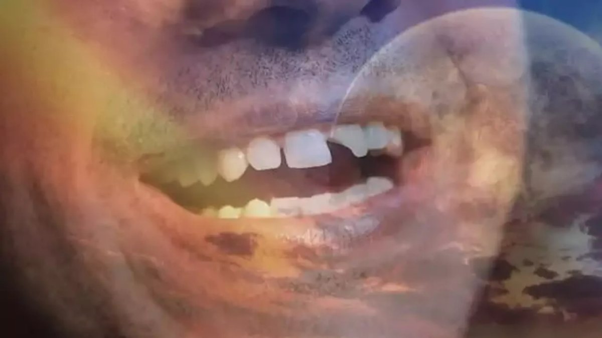 Rüyada Dişinin Kırıldığını Görmek: Anlam ve Yorumlar