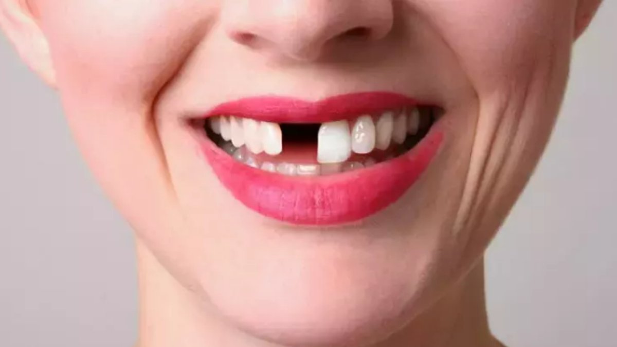 Rüyada Dişinin Düştüğünü Görmek: Anlam ve Yorumlar