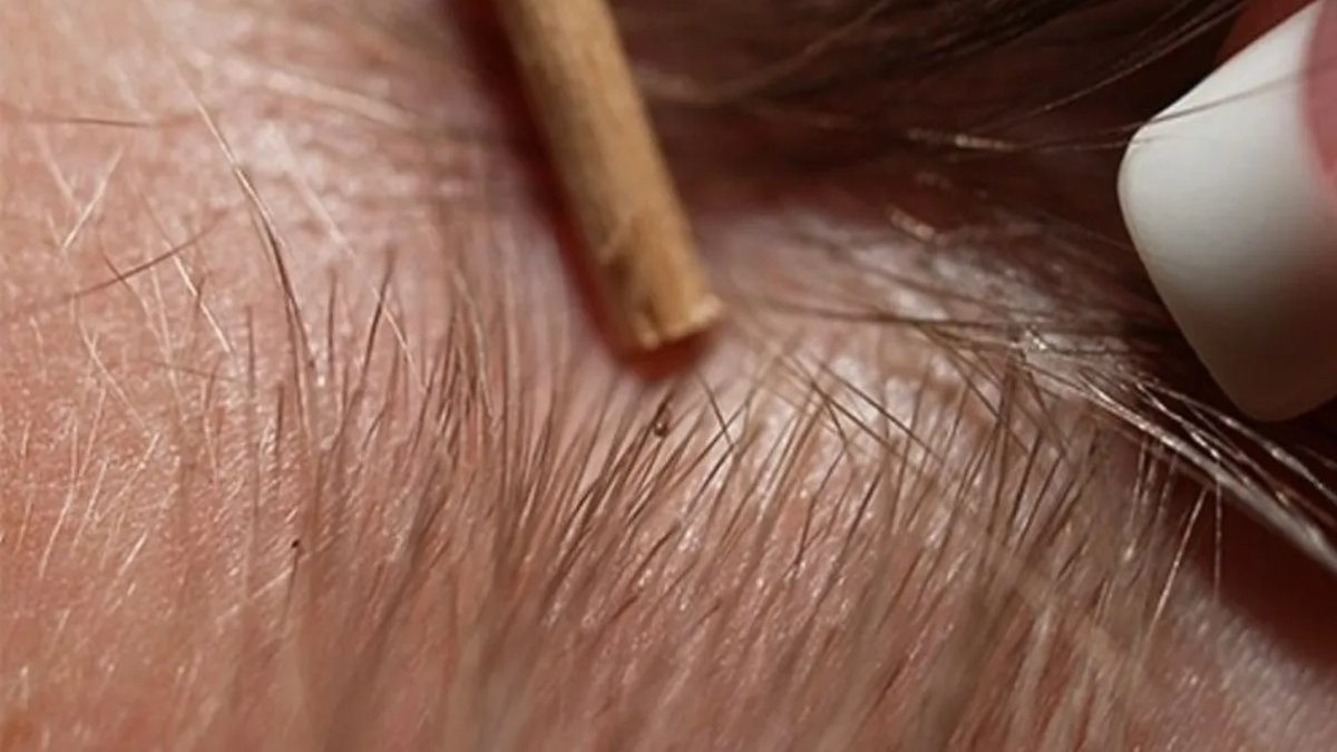 Rüyada Saçta Bit Görmek: Anlamı ve Yorumu