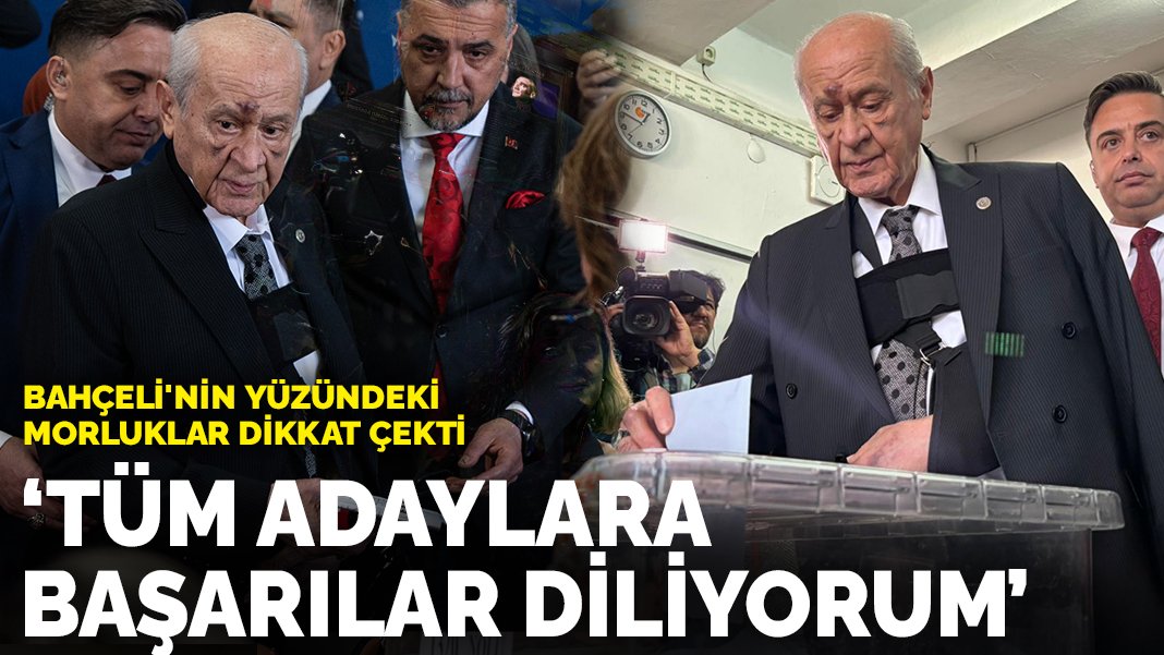 Bahçeli'nin yüzündeki morluklar dikkat çekti: Adaylara başarılar diliyorum