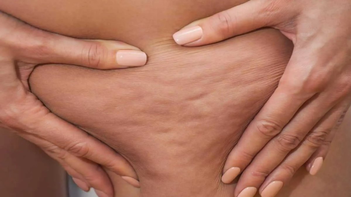 Selülit Nasıl Geçer?