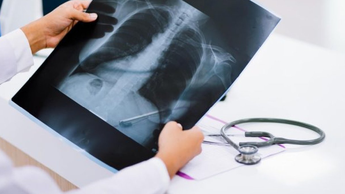 DSÖ: Her yıl bir milyon kişi tüberküloz nedeniyle hayatını kaybediyor