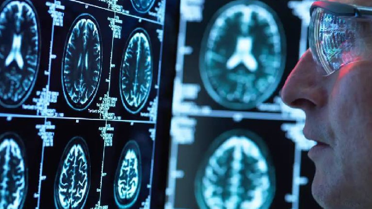 Bilim insanları, Alzheimer riskini düşürecek geni keşfetti