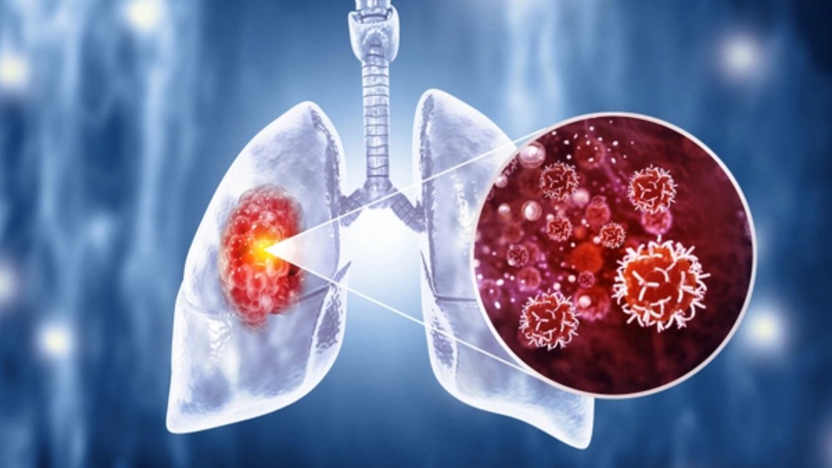 Akciğer kanseri nedir?