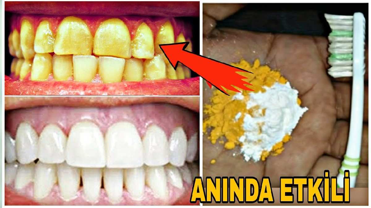 Herkes dişlerinizin beyazlık sırrını soracak! Diş taşı, sarı leke… Evde bulunan 4 malzemeyle diş sorunlarının kökünü kazıyın