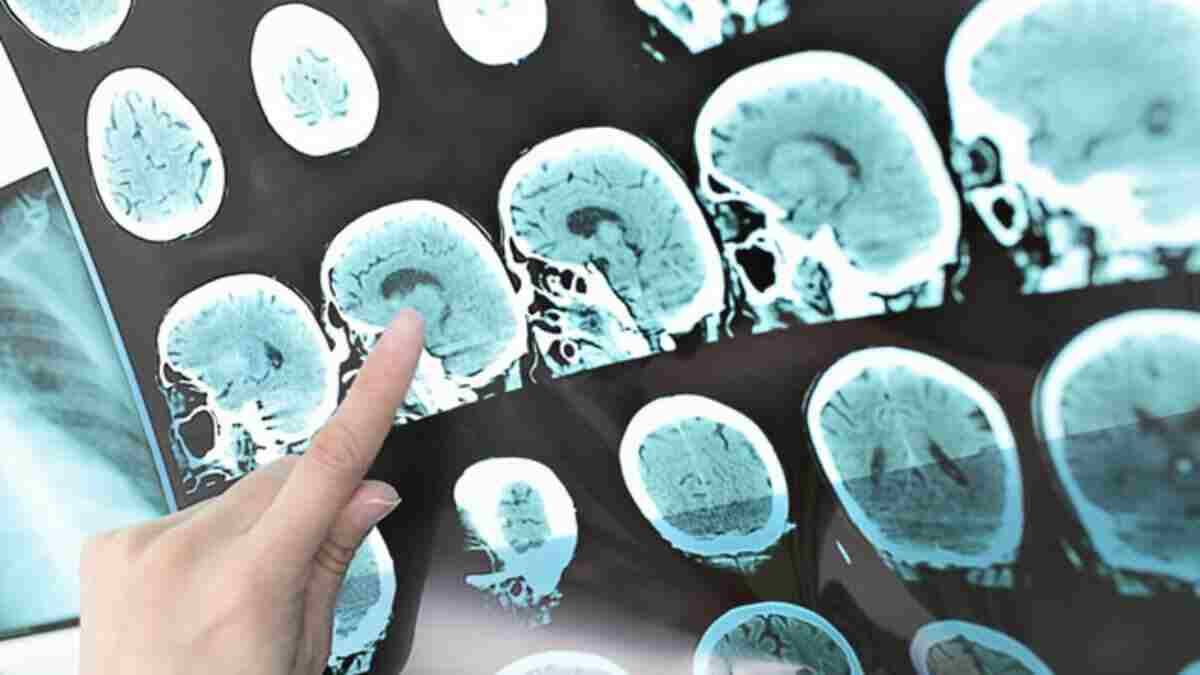 Hızla yayılıyor, vaka sayısı artıyor! Bu belirtileri hafife almayın: Türkiye’de 10 kişiden 1’i bu hastalıkla mücadele ediyor