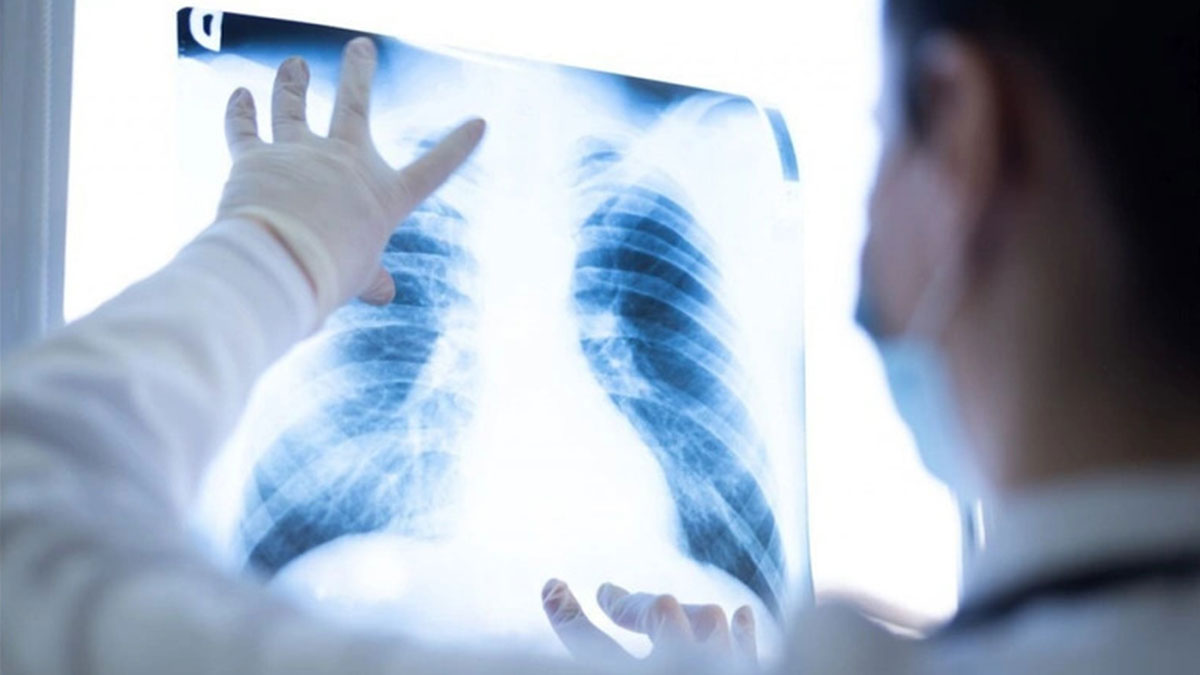 Türkiye'de her yıl kanser teşhisi konan kişi sayısı hayrete düşürdü! O tarihte vaka sayısı yüzde 50 artacak