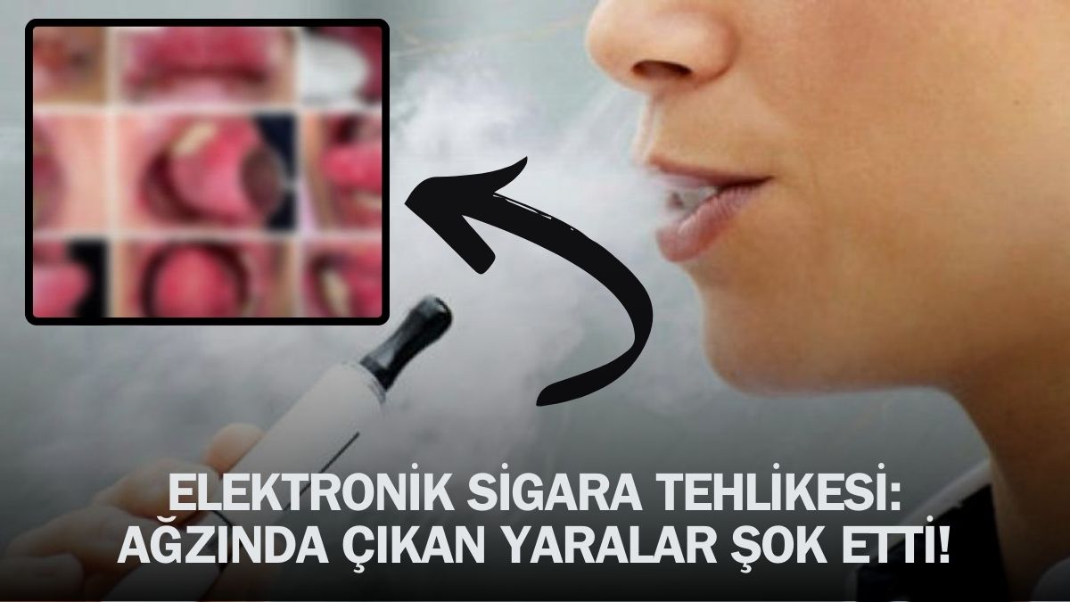 Elektronik sigara içti, ağzı bu hale geldi! Görenler bir daha ağzına bile sürmez: Doktorlar uyardı