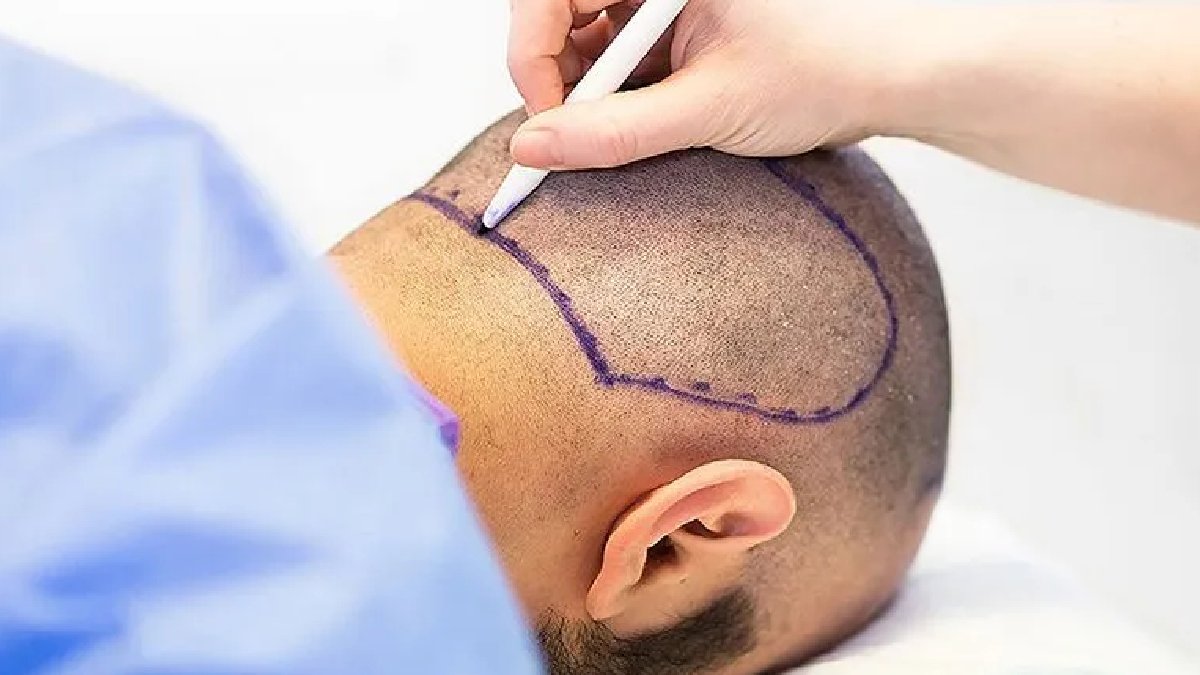 Uzmanlardan saç ektirenlere uyarı: Saç ekimi hangi mevsimlerde yapılmalı?