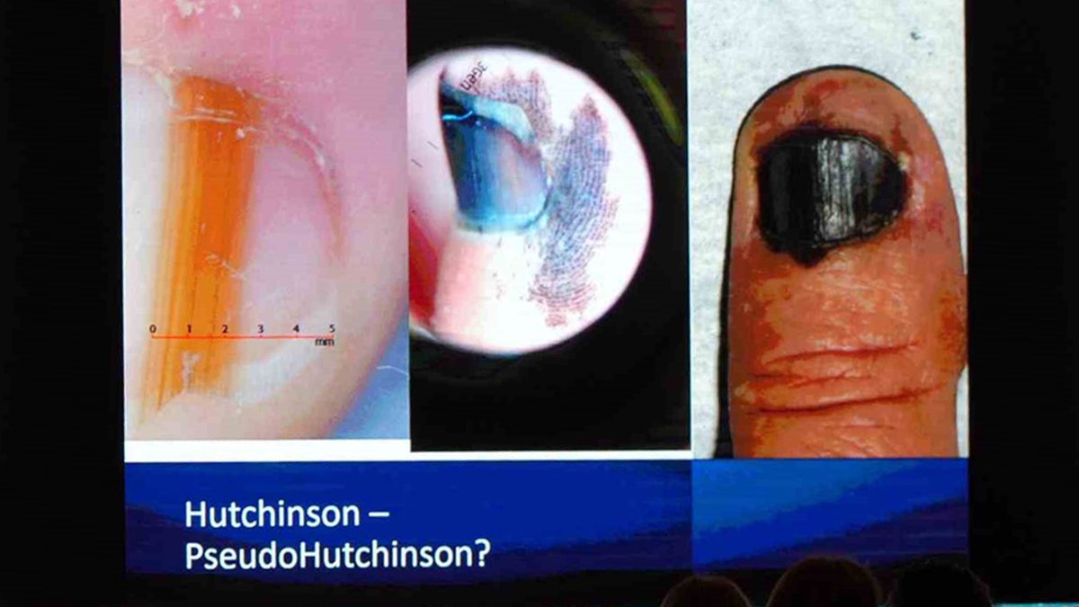 Tırnak dibindeki siyah lekeye dikkat: Cilt kanseri belirtisi olabilir