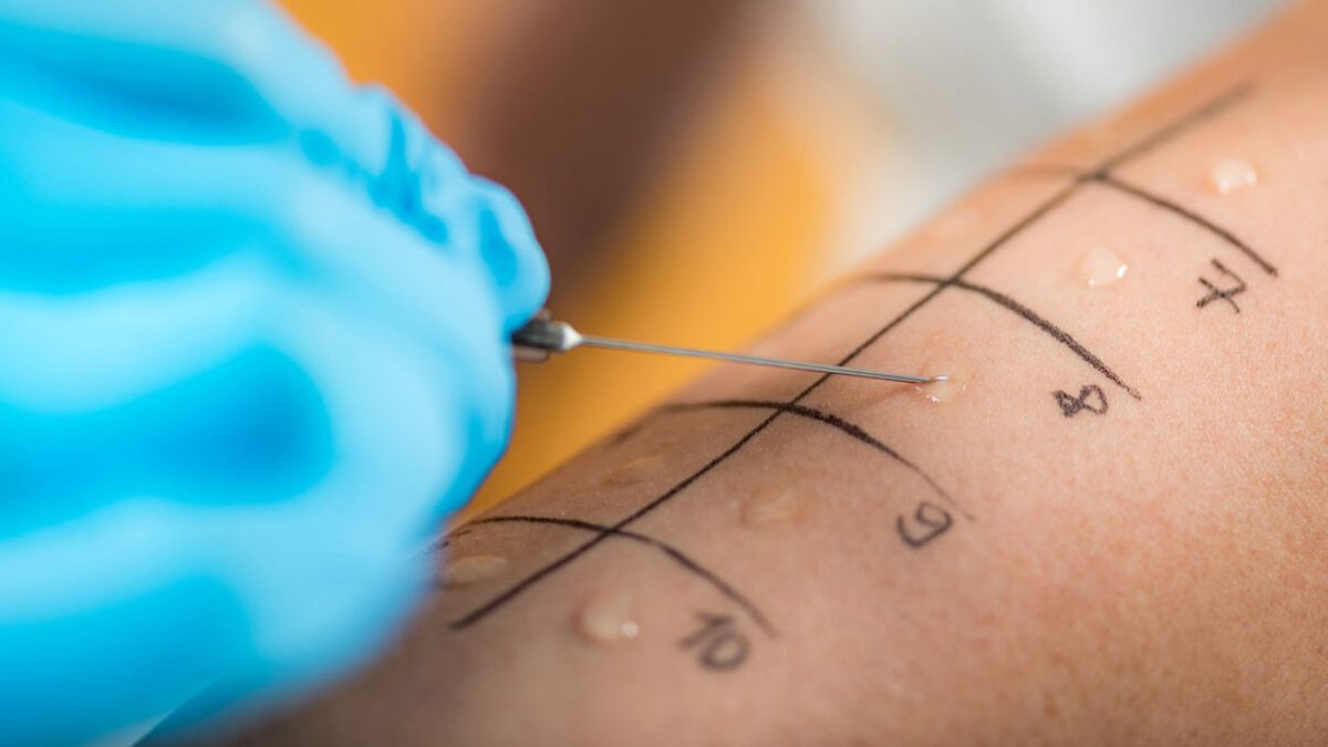 Anafilaksi son 10 yılda 7 kattan fazla arttı! Uzmanı uyardı: Hayati tehlike gelişebilir