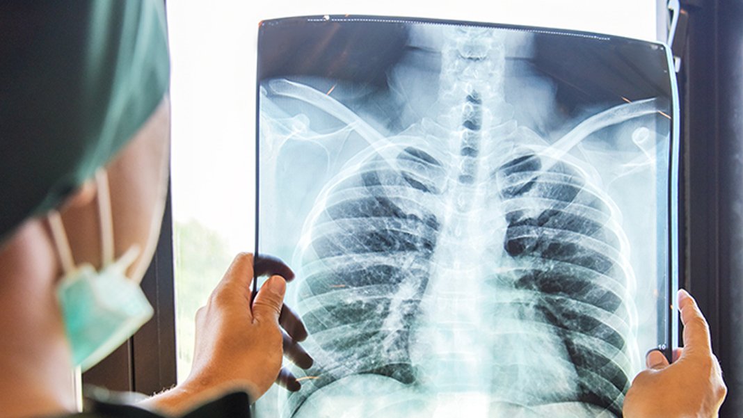 Yaz ayları geldi vakalar arttı: Türkiye'de yeni salgın alarmı