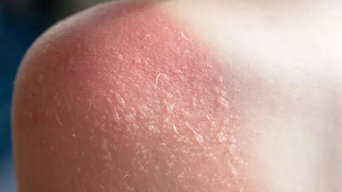 Güneş yanığına ilk müdahale ne olmalı? Uzman isim sıraladı: Bunları yapmadan evden çıkmayın