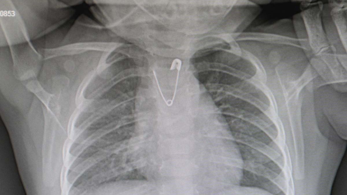 Yakasına takılan dua faciaya neden oluyordu: Çengelli iğne yutan bebek ölümden döndü